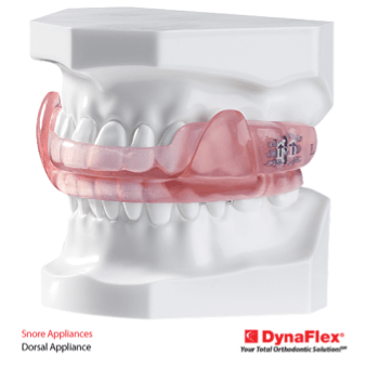 Orthodontic model showing a pink DynaFlex dorsal appliance fitted on upper and lower teeth for snoring treatment