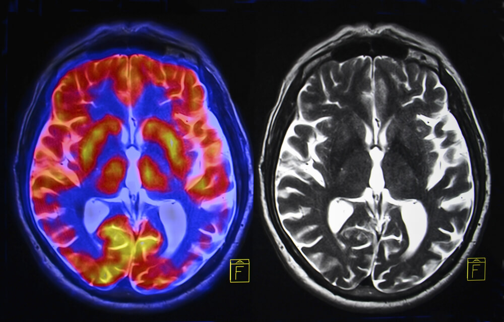 Side-by-side brain scans showing a PET scan with highlighted activity on the left and an MRI scan on the right.