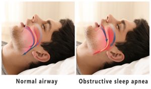The Effects of Oxygen Inhalation and Sleep Apnea