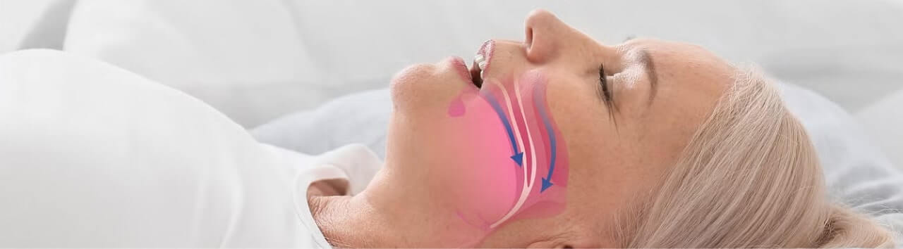 Older woman sleeping on her back with an illustrated diagram showing obstructed airflow in the throat, representing sleep apnea.