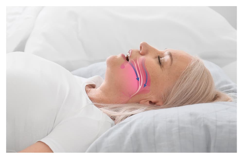 Older woman lying on bed with airway illustration showing obstructive sleep apnea.