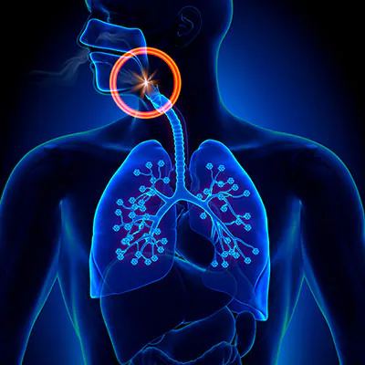 Medical illustration of human respiratory system highlighting airway obstruction near the throat