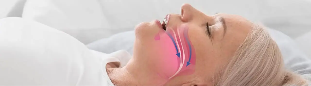 Older woman sleeping on her back with an illustrated diagram showing obstructed airflow in the throat, representing sleep apnea.